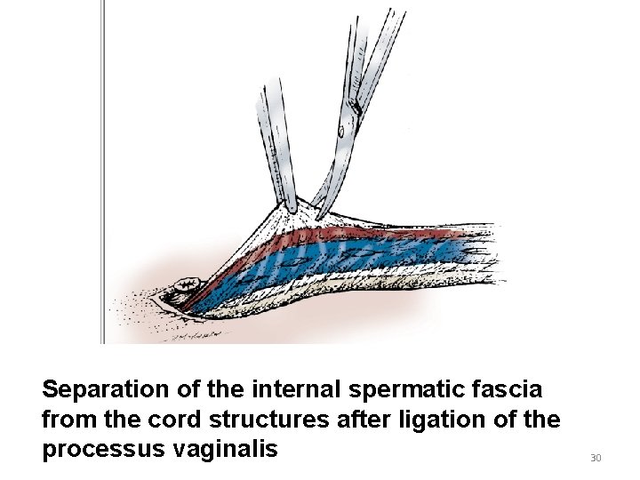 Separation of the internal spermatic fascia from the cord structures after ligation of the