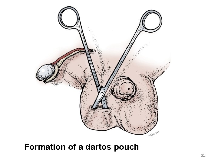 Formation of a dartos pouch 31 