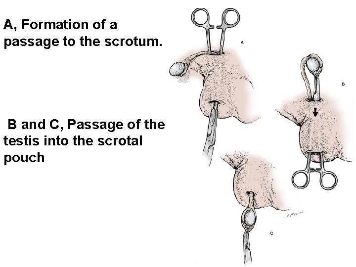 A, Formation of a passage to the scrotum. B and C, Passage of the
