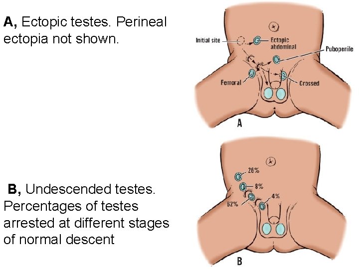 A, Ectopic testes. Perineal ectopia not shown. B, Undescended testes. Percentages of testes arrested