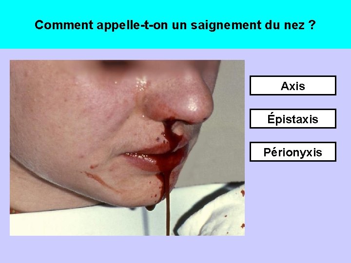 Comment appelle-t-on un saignement du nez ? Axis Épistaxis Périonyxis 