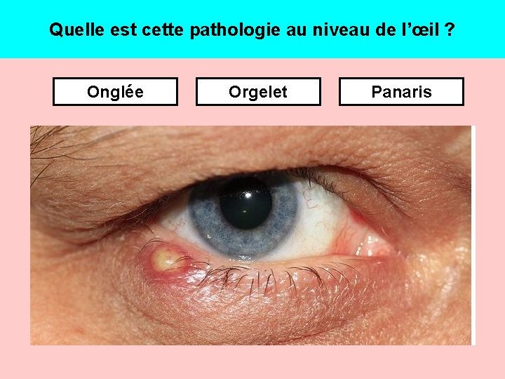 Quelle est cette pathologie au niveau de l’œil ? Onglée Orgelet Panaris 