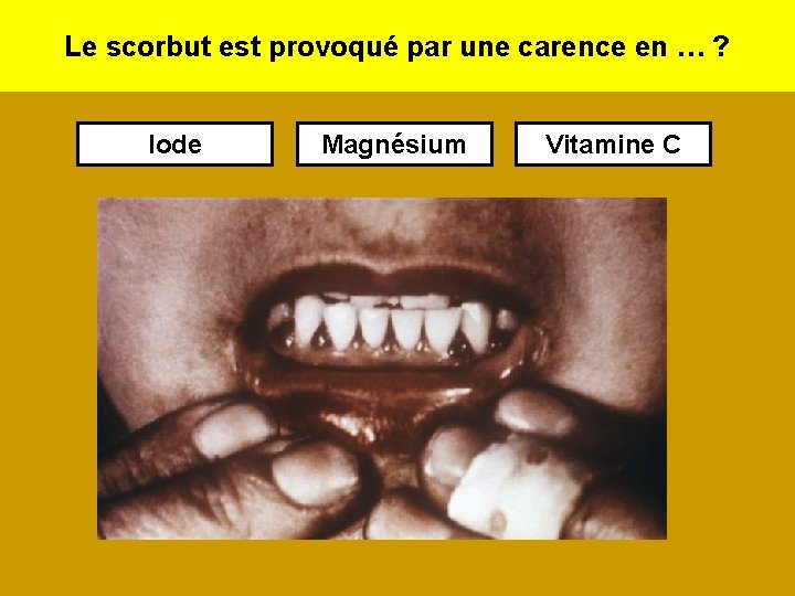 Le scorbut est provoqué par une carence en … ? Iode Magnésium Vitamine C