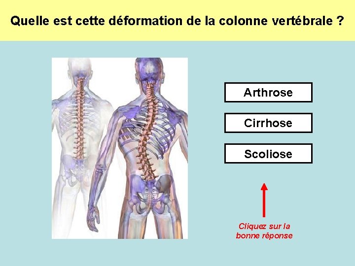 Quelle est cette déformation de la colonne vertébrale ? Arthrose Cirrhose Scoliose Cliquez sur