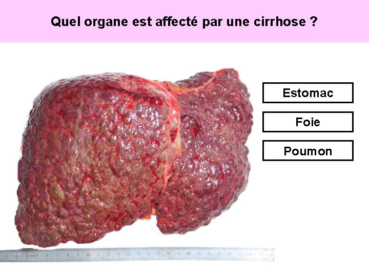 Quel organe est affecté par une cirrhose ? Estomac Foie Poumon 