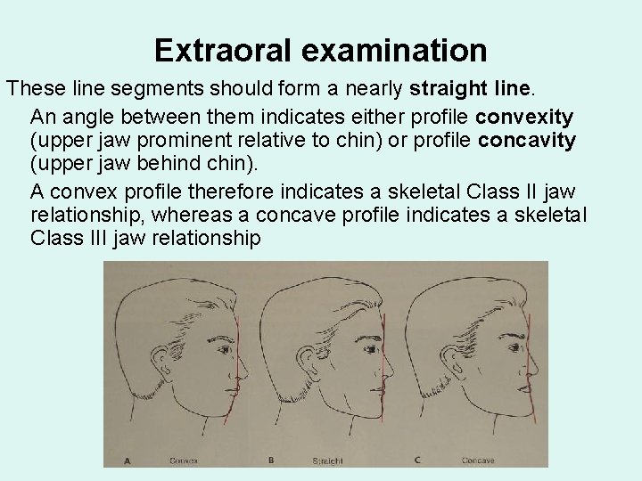 Extraoral examination These line segments should form a nearly straight line. An angle between