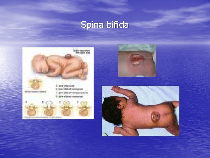 Spina bifida Spina bifida