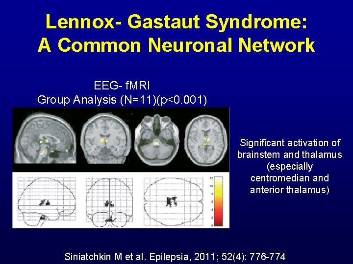 Lennox- Gastaut Syndrome: A Common Neuronal Network EEG- f. MRI Group Analysis (N=11)(p<0. 001)