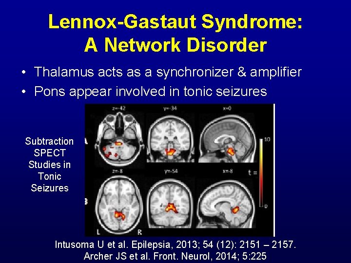 Lennox-Gastaut Syndrome: A Network Disorder • Thalamus acts as a synchronizer & amplifier •