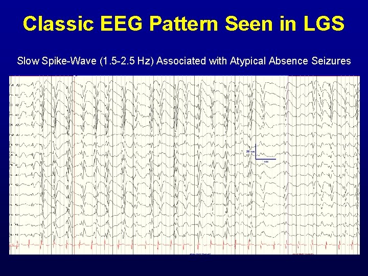 Classic EEG Pattern Seen in LGS Slow Spike-Wave (1. 5 -2. 5 Hz) Associated