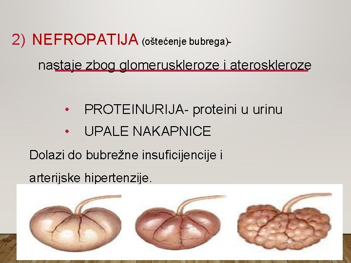 2) NEFROPATIJA (oštećenje bubrega)nastaje zbog glomeruskleroze i ateroskleroze • PROTEINURIJA- proteini u urinu •