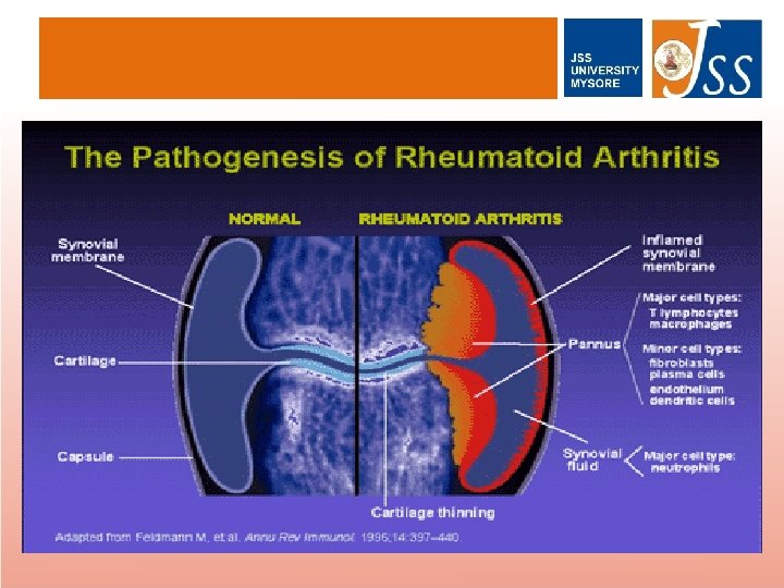 Rheumatoid arthritis A boka fertőző ízületi gyulladása