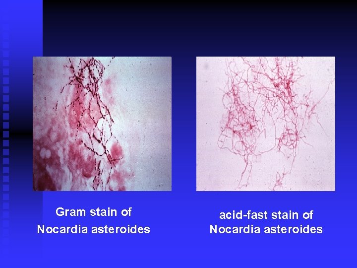 Gram stain of Nocardia asteroides acid-fast stain of Nocardia asteroides 