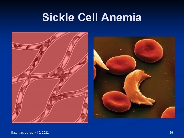 Sickle Cell Anemia Saturday, January 15, 2022 39 