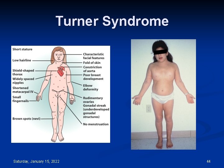 Turner Syndrome Saturday, January 15, 2022 44 