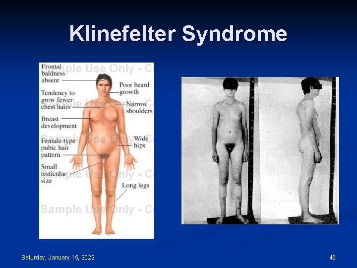 Klinefelter Syndrome Saturday, January 15, 2022 46 