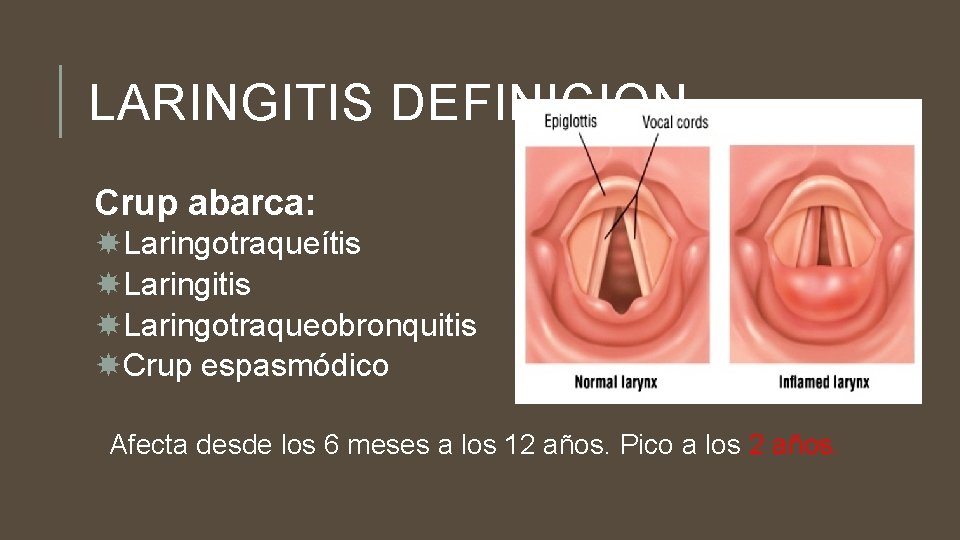 LARINGITIS DEFINICION Crup abarca: Laringotraqueítis Laringitis Laringotraqueobronquitis Crup espasmódico Afecta desde los 6 meses