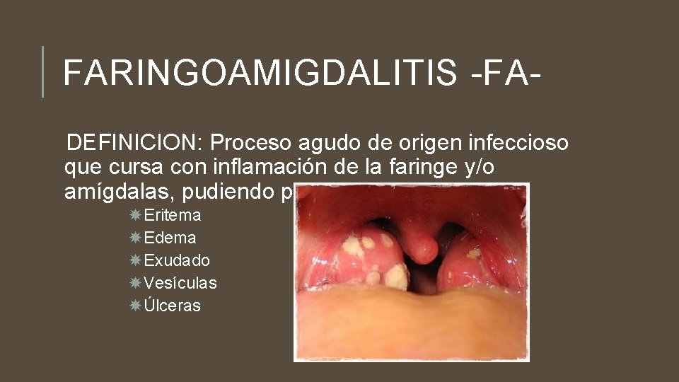 FARINGOAMIGDALITIS -FADEFINICION: Proceso agudo de origen infeccioso que cursa con inflamación de la faringe