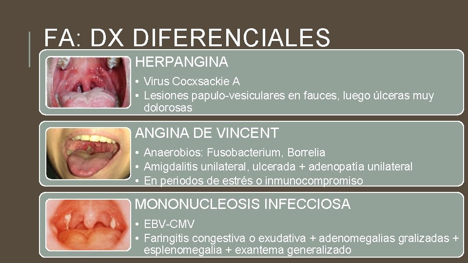 FA: DX DIFERENCIALES HERPANGINA • Virus Cocxsackie A • Lesiones papulo-vesiculares en fauces, luego