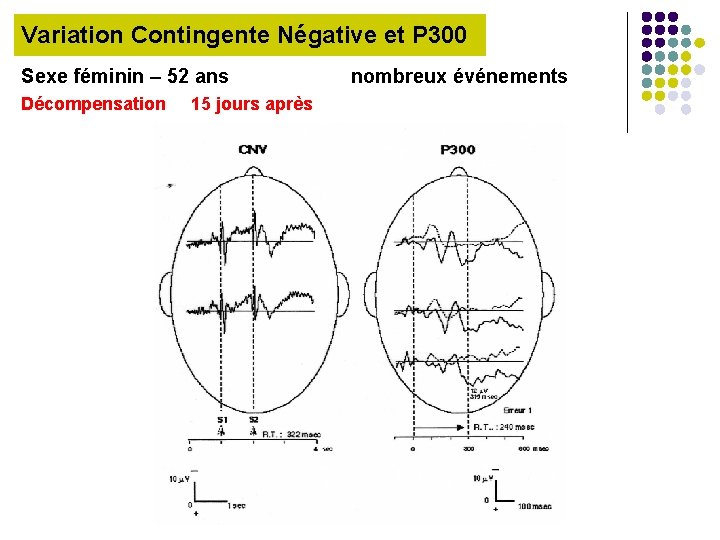 Variation Contingente Négative et P 300 Sexe féminin – 52 ans Décompensation 15 jours
