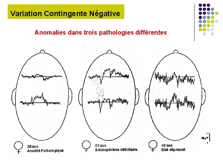 Variation Contingente Négative Anomalies dans trois pathologies différentes 