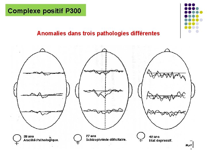 Complexe positif P 300 Anomalies dans trois pathologies différentes 