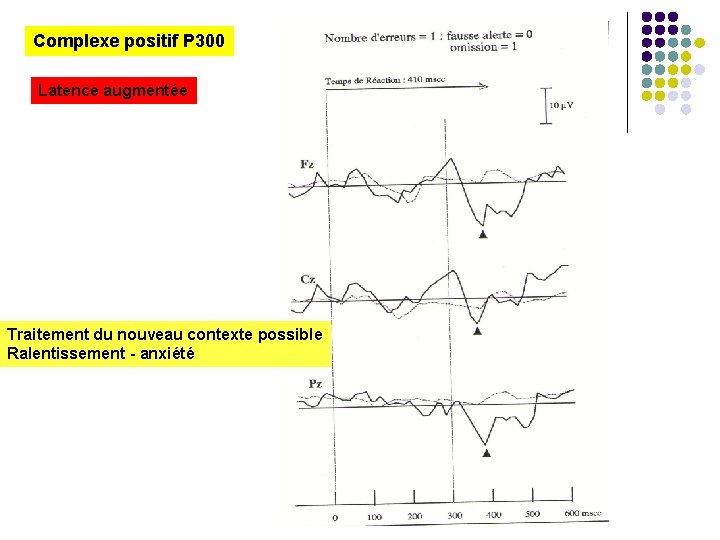 Complexe positif P 300 Latence augmentée Traitement du nouveau contexte possible Ralentissement - anxiété