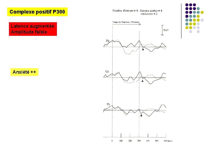 Complexe positif P 300 Latence augmentée Amplitude faible Anxiété ++ 