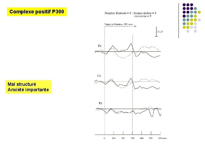 Complexe positif P 300 Mal structuré Anxiété importante 