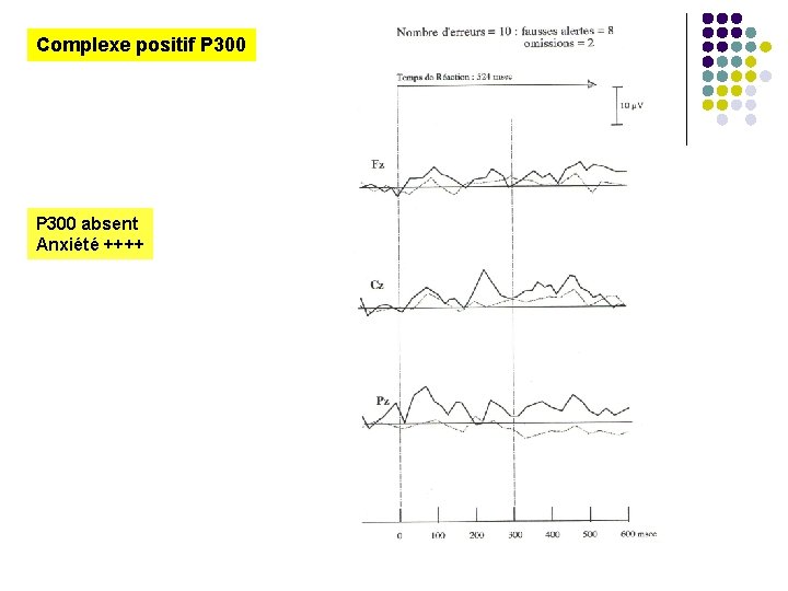 Complexe positif P 300 absent Anxiété ++++ 