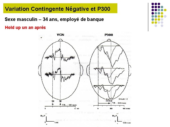 Variation Contingente Négative et P 300 Sexe masculin – 34 ans, employé de banque