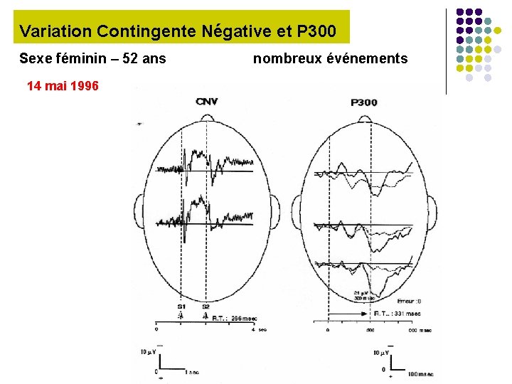 Variation Contingente Négative et P 300 Sexe féminin – 52 ans 14 mai 1996