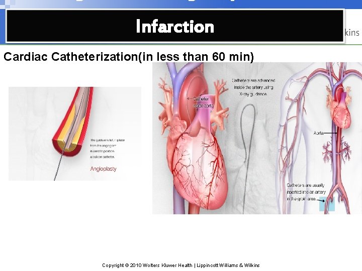 Infarction Cardiac Catheterization(in less than 60 min) Copyright © 2010 Wolters Kluwer Health |