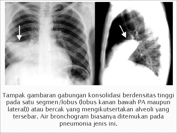 Tampak gambaran gabungan konsolidasi berdensitas tinggi pada satu segmen/lobus (lobus kanan bawah PA maupun