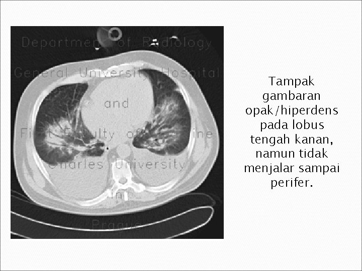 Tampak gambaran opak/hiperdens pada lobus tengah kanan, namun tidak menjalar sampai perifer. 