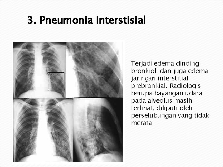 3. Pneumonia Interstisial Terjadi edema dinding bronkioli dan juga edema jaringan interstitial prebronkial. Radiologis