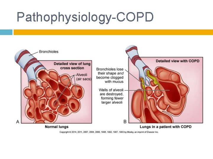 Pathophysiology-COPD 