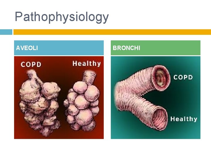 Pathophysiology AVEOLI BRONCHI 