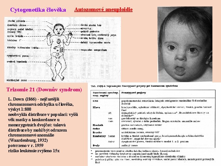 Cytogenetika člověka Autozomové aneuploidie Trizomie 21 (Downův syndrom) L. Down (1866) - nejčastější chromozomová