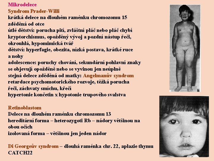 Mikrodelece Syndrom Prader-Willi krátká delece na dlouhém raménku chromozomu 15 zděděná od otce útlé