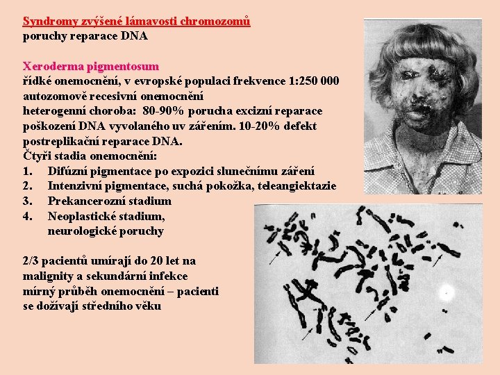 Syndromy zvýšené lámavosti chromozomů poruchy reparace DNA Xeroderma pigmentosum řídké onemocnění, v evropské populaci