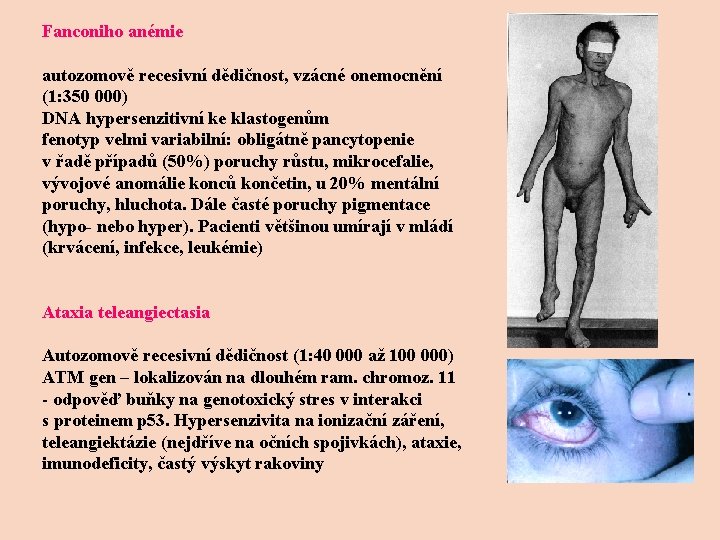 Fanconiho anémie autozomově recesivní dědičnost, vzácné onemocnění (1: 350 000) DNA hypersenzitivní ke klastogenům