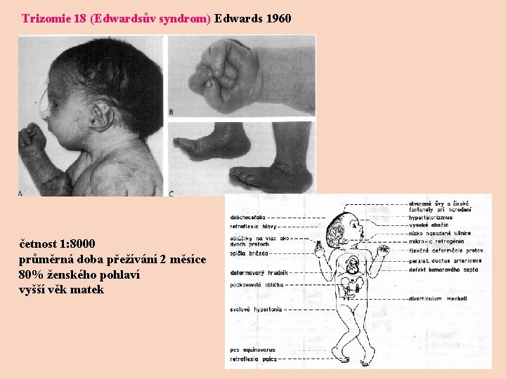 Trizomie 18 (Edwardsův syndrom) Edwards 1960 četnost 1: 8000 průměrná doba přežívání 2 měsíce