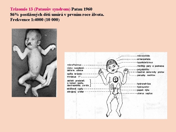 Trizomie 13 (Patauův syndrom) Patau 1960 86% postižených dětí umírá v prvním roce života.