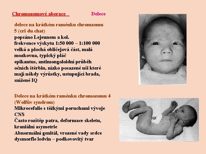 Chromozomové aberace Delece delece na krátkém raménku chromzomu 5 (cri du chat) popsáno Lejeunem Chromozomové aberace Delece delece na krátkém raménku chromzomu 5 (cri du chat) popsáno Lejeunem