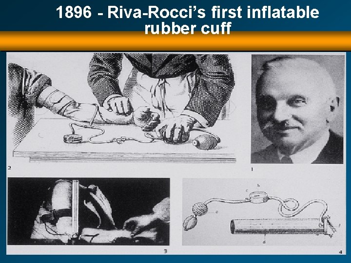 1896 - Riva-Rocci’s first inflatable rubber cuff 
