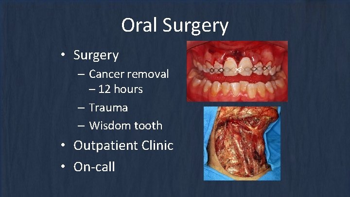 Oral Surgery • Surgery – Cancer removal – 12 hours – Trauma – Wisdom