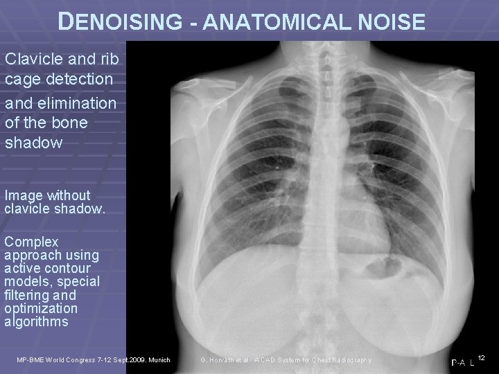 DENOISING - ANATOMICAL NOISE Clavicle and rib cage detection and elimination of the bone