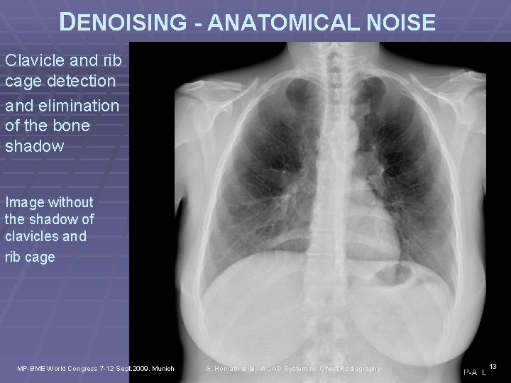 DENOISING - ANATOMICAL NOISE Clavicle and rib cage detection and elimination of the bone