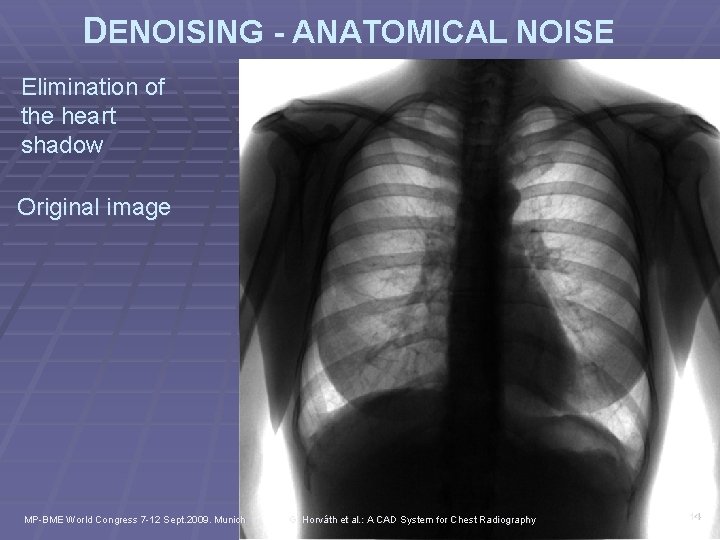 DENOISING - ANATOMICAL NOISE Elimination of the heart shadow Original image MP-BME World Congress